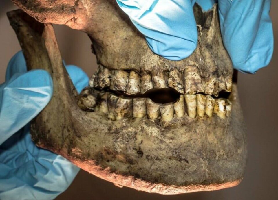 The wear on this man's teeth indicates that he smoked tobacco. The chalk pipe has worn holes in the row of teeth.